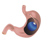 Balón Gástrico por endoscopia.
