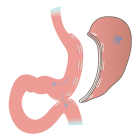 Sasi Bypass. Cirugía Diabetes Tipo 2 y Obesidad Mórbida.