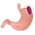 Extracción del Bazo