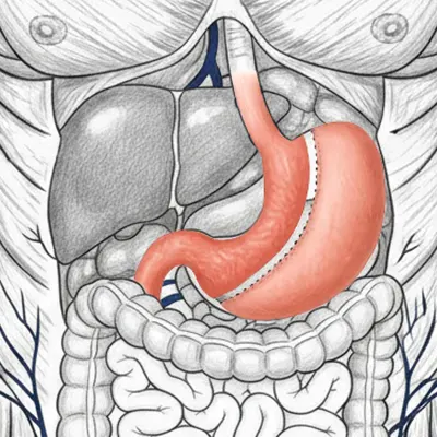 Img-Dr_Adolfo_Uribe-Manga gástrica