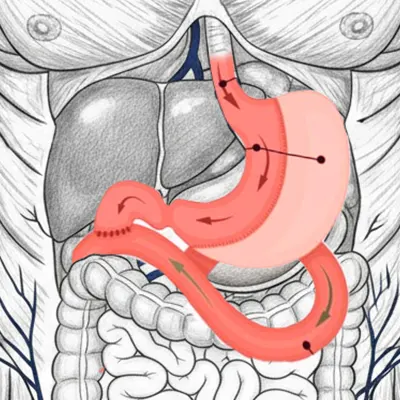Img-Dr_Adolfo_Uribe-Sasi Bypass